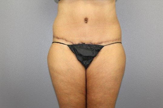 Tummy Tuck Before & After