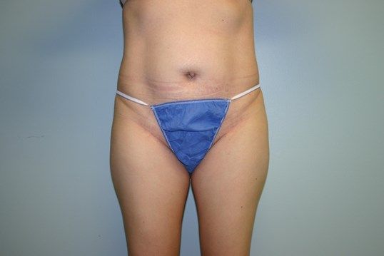Tummy Tuck Before & After