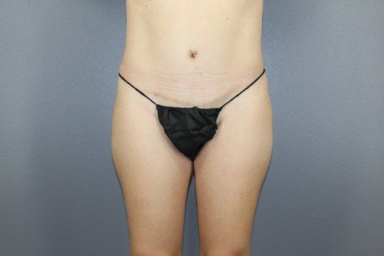 Tummy Tuck Before & After