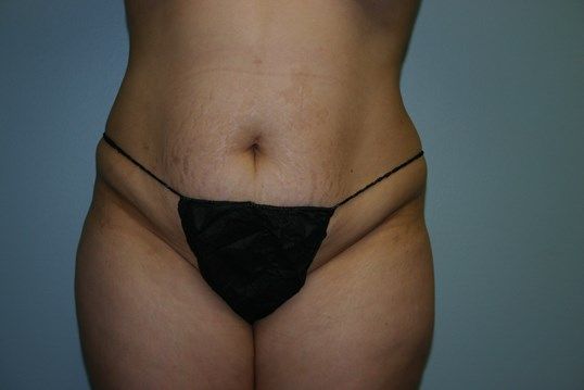 Tummy Tuck Before & After