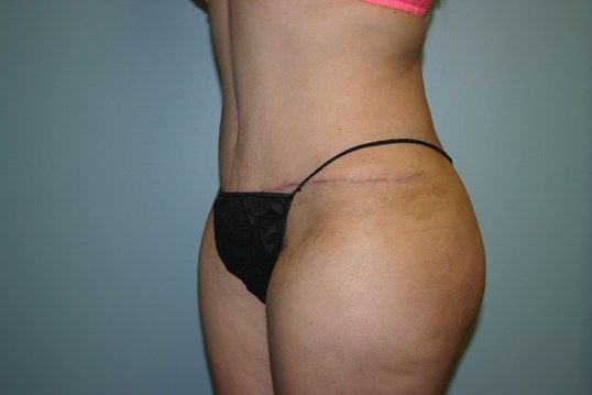 Tummy Tuck Before & After
