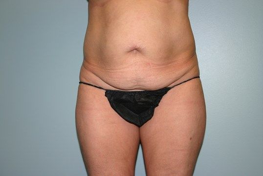 Tummy Tuck Before & After