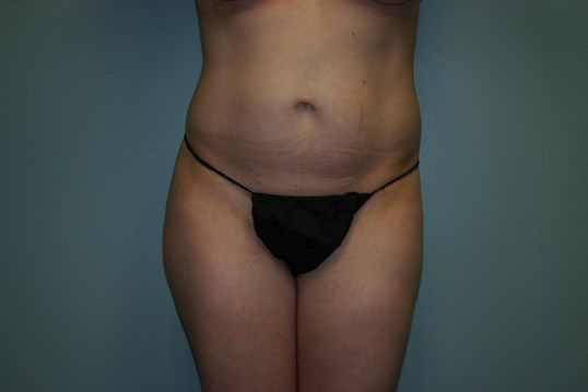 Tummy Tuck Before & After