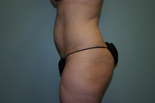 Tummy Tuck Before & After