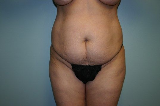 Tummy Tuck Before & After