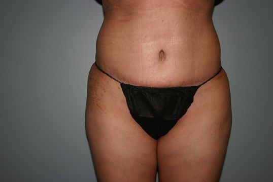Tummy Tuck Before & After