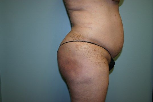 Tummy Tuck Before & After