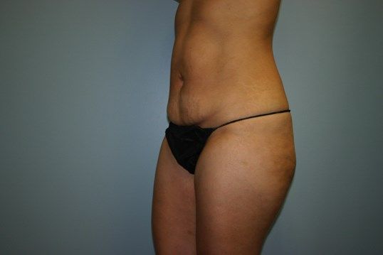 Tummy Tuck Before & After