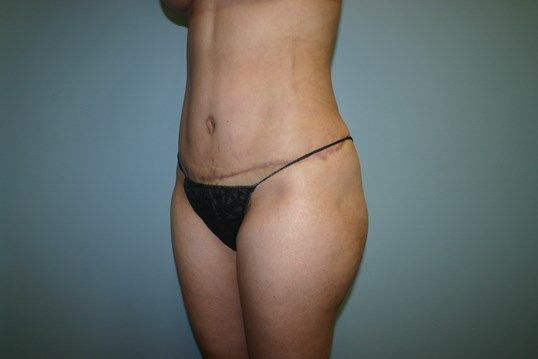 Tummy Tuck Before & After