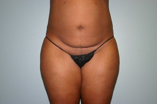 Tummy Tuck Before & After