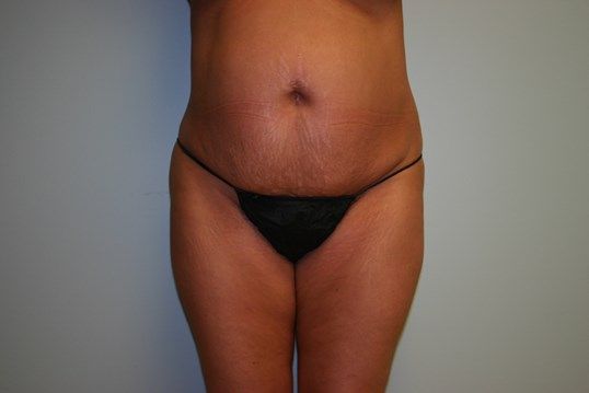 Tummy Tuck Before & After