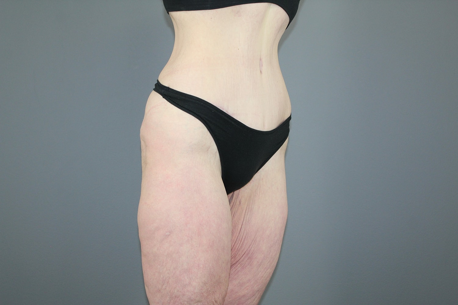 Tummy Tuck Before & After