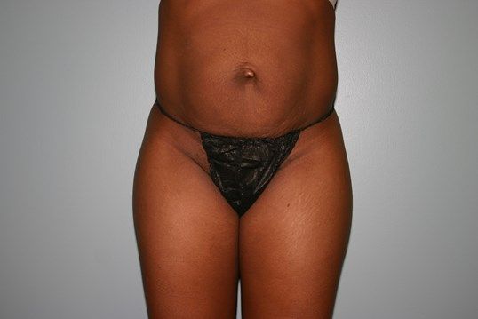 Tummy Tuck Before & After