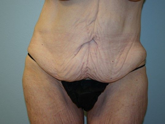 Tummy Tuck Before & After
