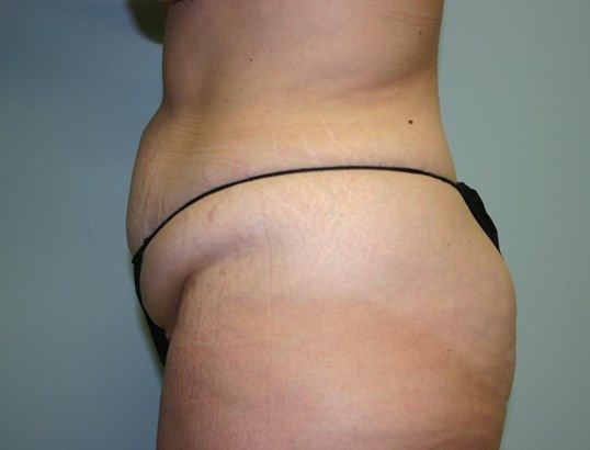 Tummy Tuck Before & After