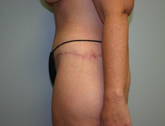 Tummy Tuck Before & After