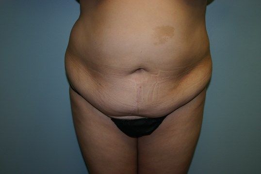 Tummy Tuck Before & After