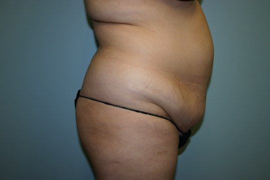 Tummy Tuck Before & After