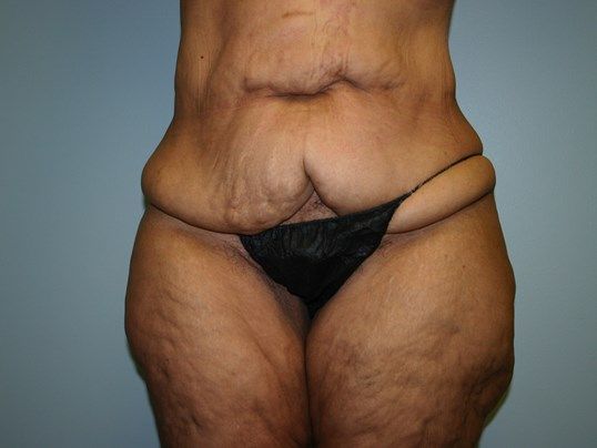 Tummy Tuck Before & After