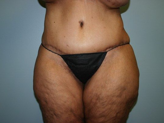 Tummy Tuck Before & After