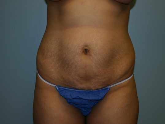 Tummy Tuck Before & After