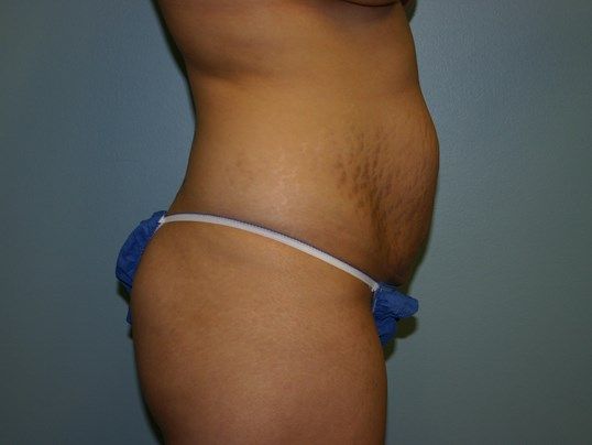 Tummy Tuck Before & After