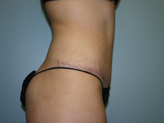 Tummy Tuck Before & After