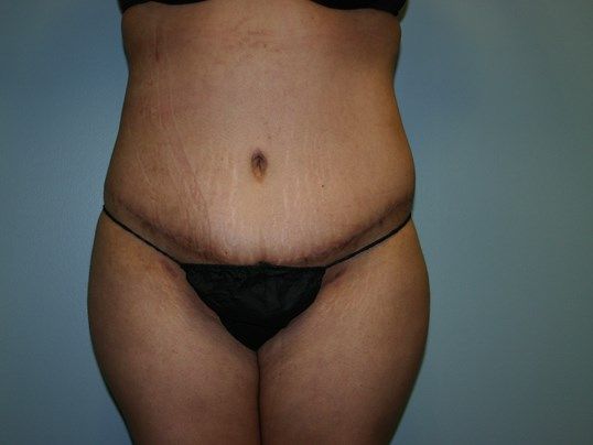 Tummy Tuck Before & After