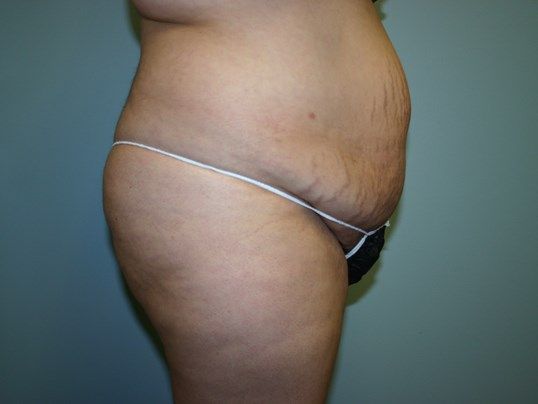 Tummy Tuck Before & After