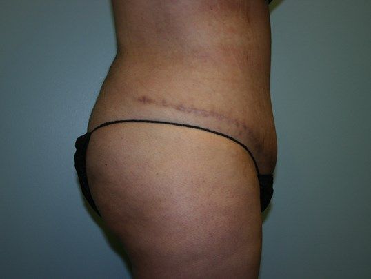 Tummy Tuck Before & After