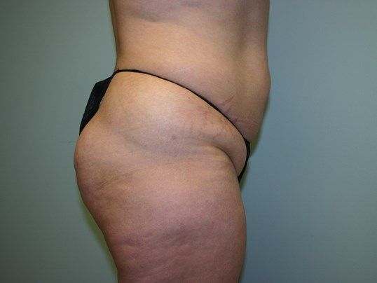 Tummy Tuck Before & After