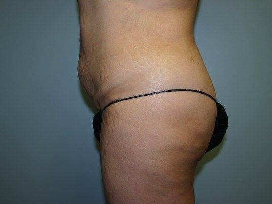 Tummy Tuck Before & After