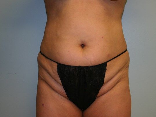 Tummy Tuck Before & After
