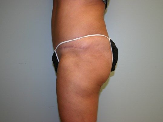 Tummy Tuck Before & After