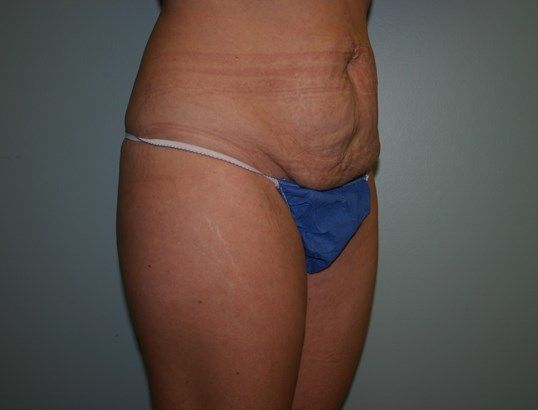 Tummy Tuck Before & After