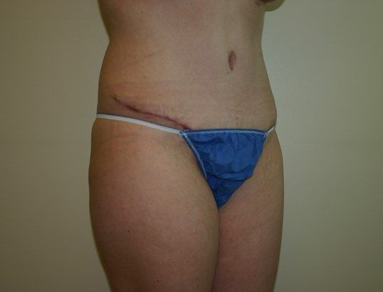 Tummy Tuck Before & After