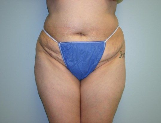Tummy Tuck Before & After