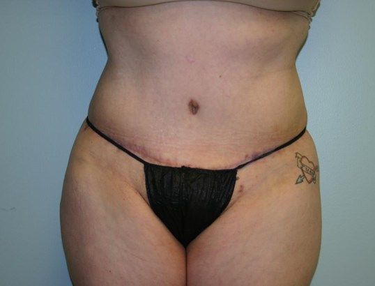 Tummy Tuck Before & After
