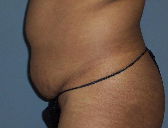 Tummy Tuck Before & After
