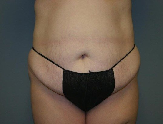 Tummy Tuck Before & After