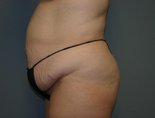 Tummy Tuck Before & After