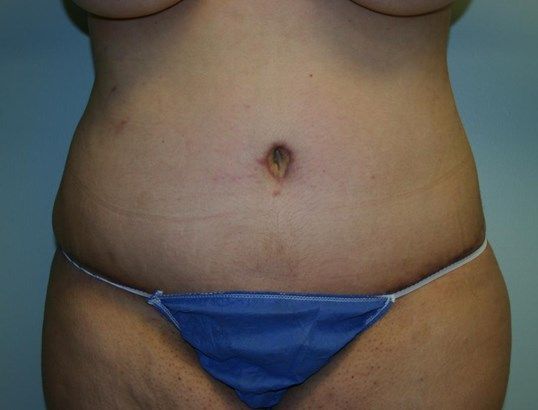 Tummy Tuck Before & After