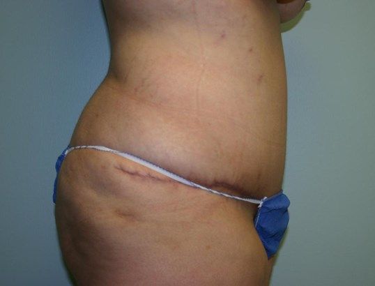 Tummy Tuck Before & After