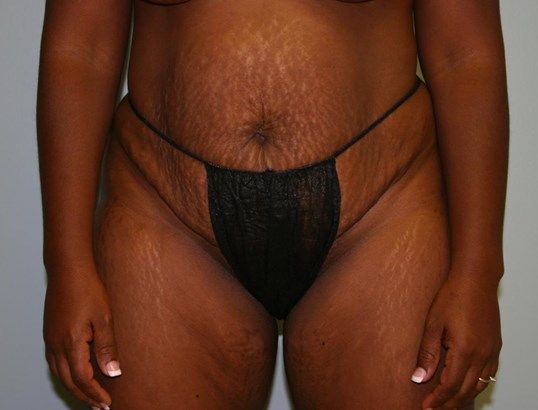 Tummy Tuck Before & After