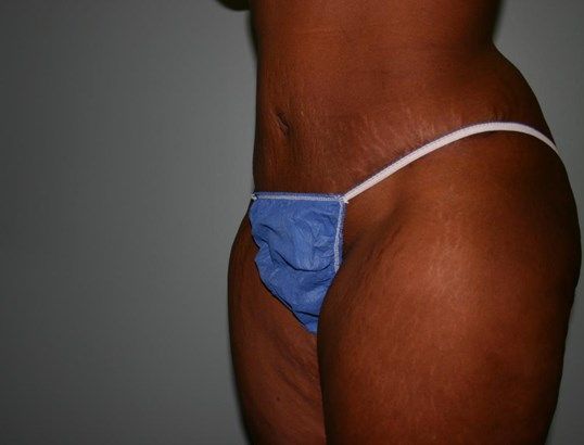 Tummy Tuck Before & After