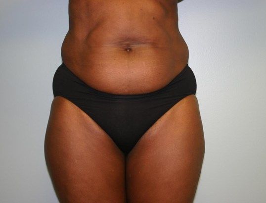 Tummy Tuck Before & After
