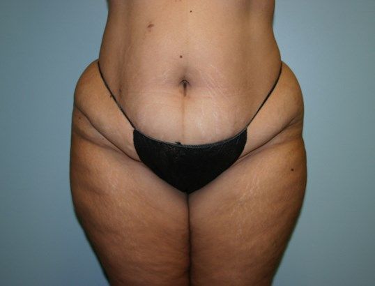 Tummy Tuck Before & After