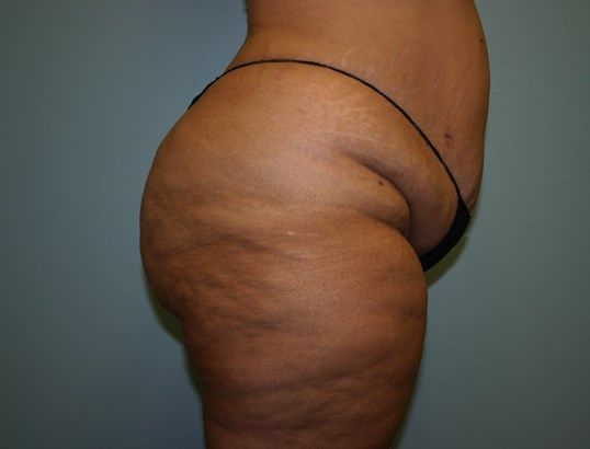 Tummy Tuck Before & After