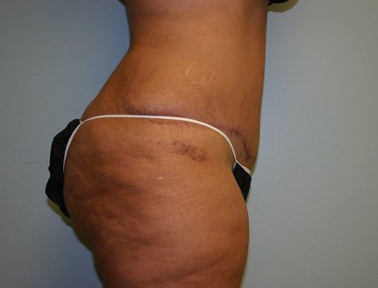 Tummy Tuck Before & After
