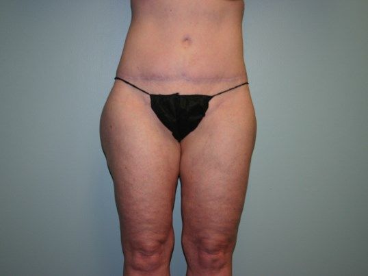 Tummy Tuck Before & After